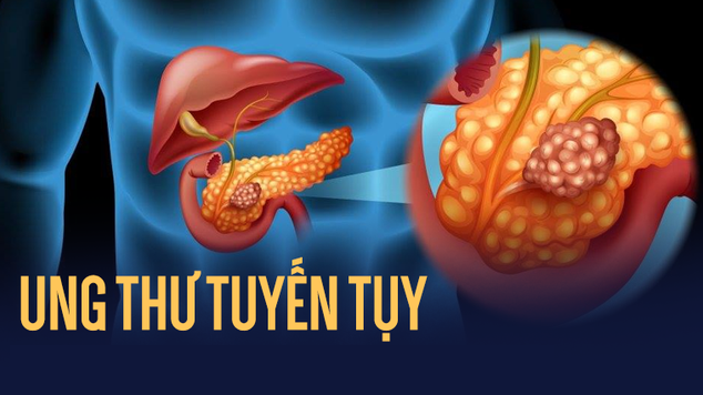 Những dấu hiệu cảnh báo ung thư tụy