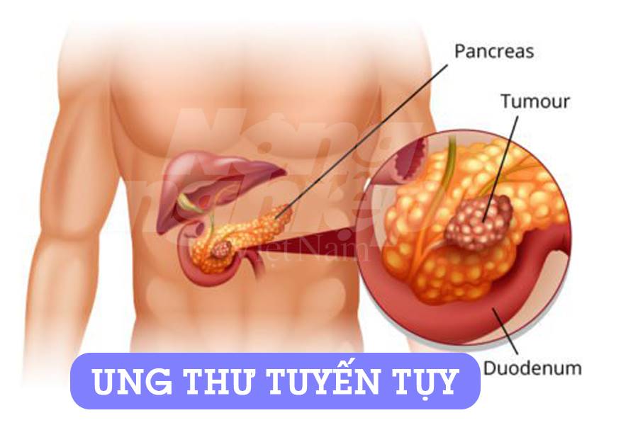 Ung thư tụy: Nguyên nhân, triệu chứng, chẩn đoán và phòng ngừa